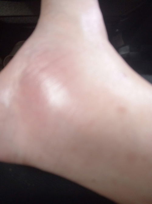 Adakah wajar bengkak buku lali.. Semasa mengandung dan apakah faktor utama penyebabnye?