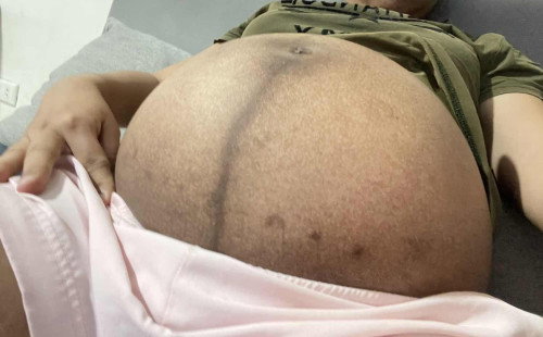 Ano po kaya ito dark dark spot sa tummy ko?