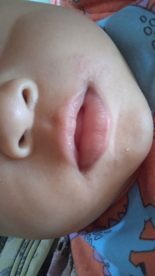 Iritasi daerah bibir bayi
