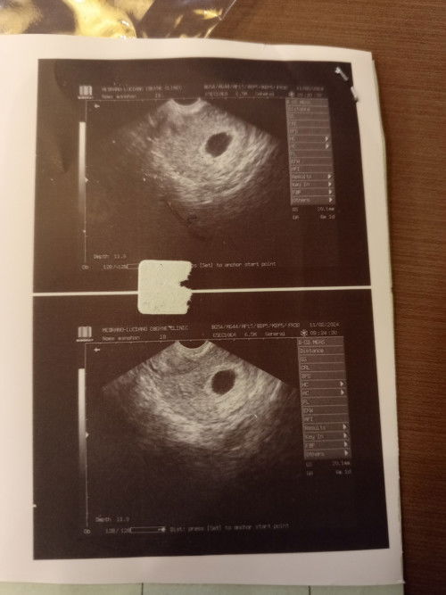 6weeks Gestational Sac only