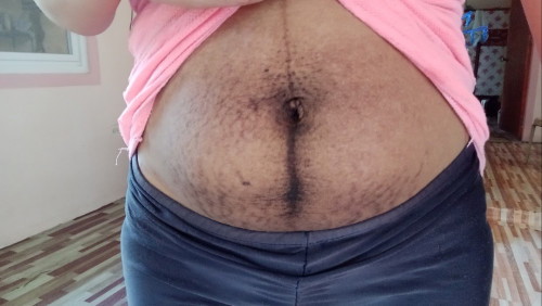 Stretchmarks