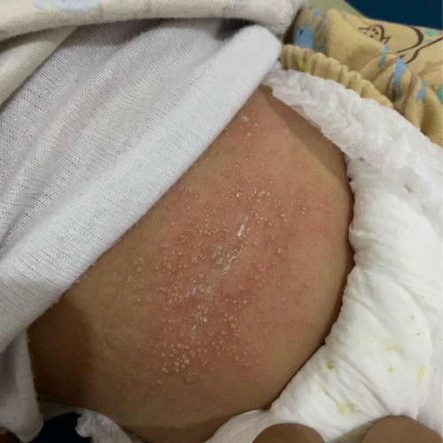 gatal gatal pda anak