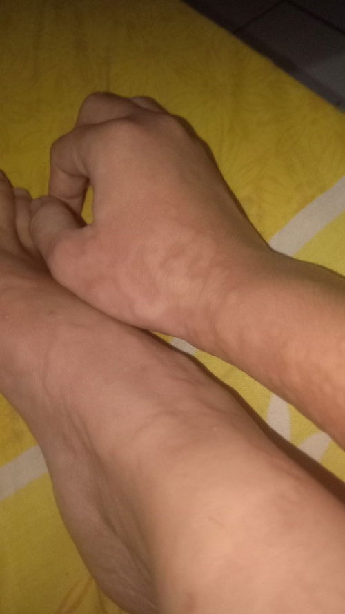 Gatal2 seluruh badan