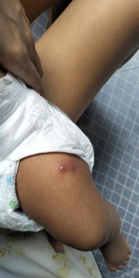 Normal lang po ba yan sa hita ng baby ko nagpaimmunize kmi nagkaroon ng nana?