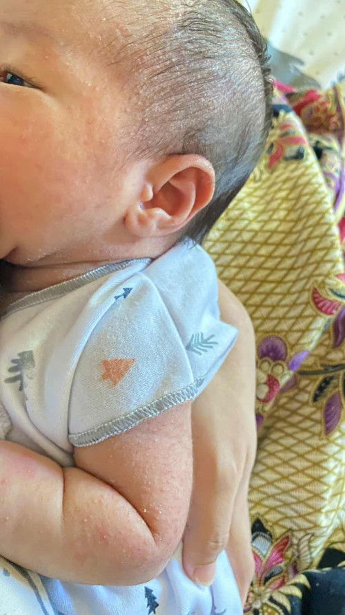 Kulit bayi ruam
