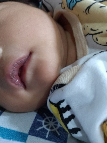 Normal Poba sa newborn Ang kulang Ng lips..