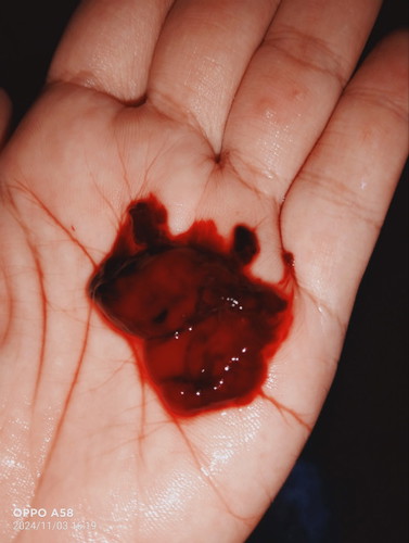 Salam.. ni ke kantung tu?Baru je kluar sdri. Xde rasa sakit apa pun. Kluar darah skit2 dh 4 ari.