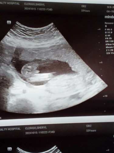 Gander 16 weeks ultrasound ano kaya