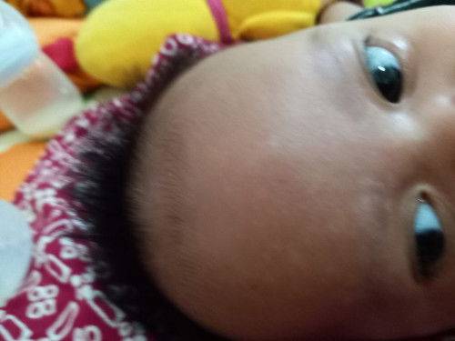 Bercak putih di kulit bayi