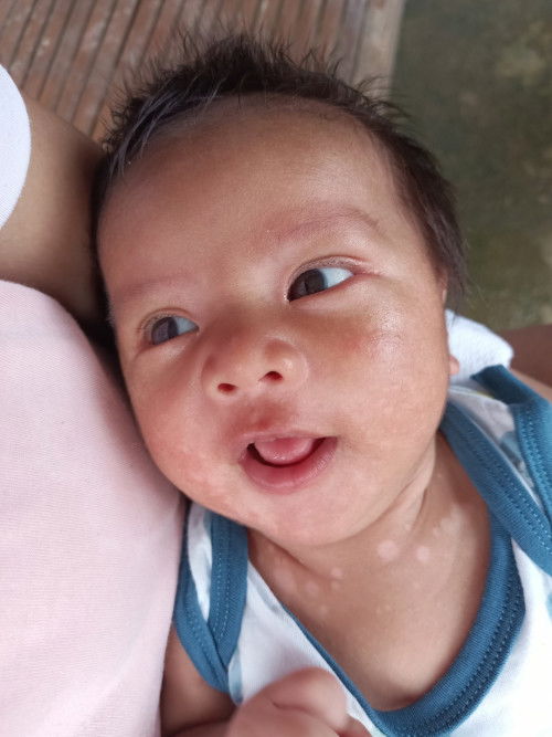 Ezcazort cream(nagdiscoloration si baby ko)