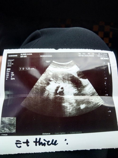 Bleeding ,kandungan slmt atau tidak?