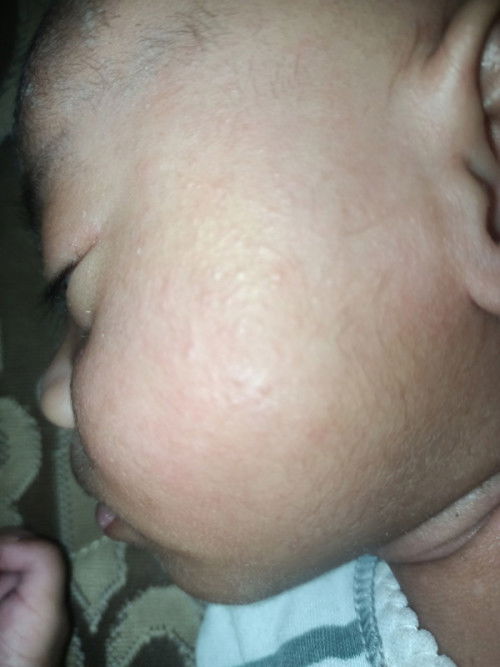 Perbedaan alergi dan biang keringat