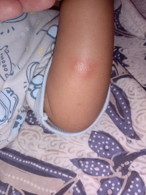 Gara gara gigitan nyamuk