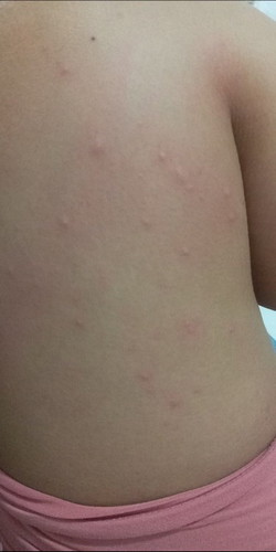 37 weeks rashes