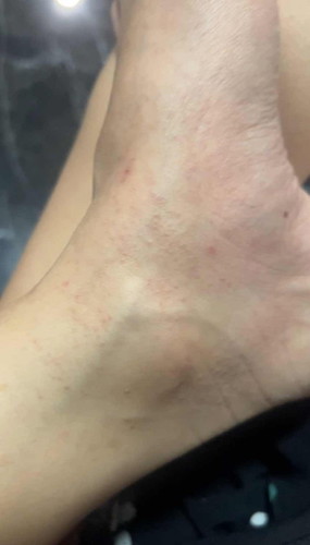 แม่ๆบ้านไหนมีผื่นคันขึ้นแบบนี้