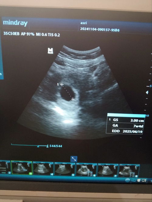 Udh mau 7Week tapi belom keliatan Jadin nya😔