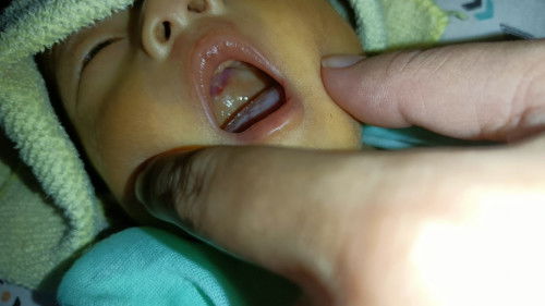 Sariawan di langit-langit mulut pada bayi Newborn 22 hari