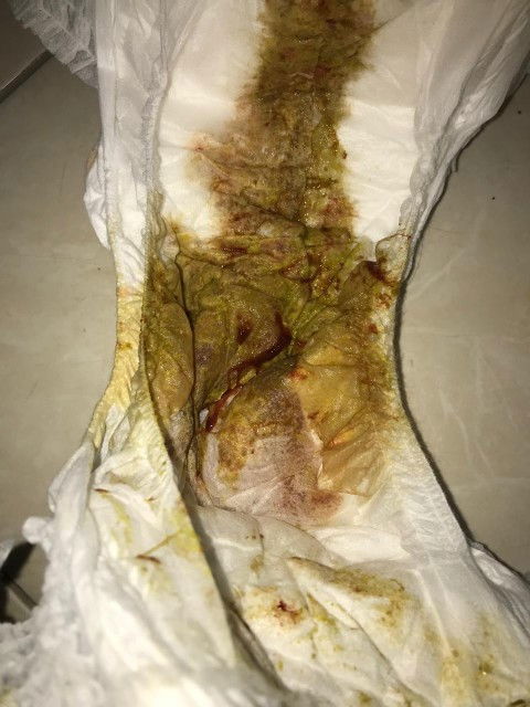 BAB anak berlendir dan berdarah