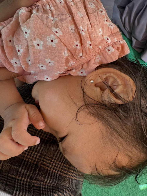 bercak putih wajah anak 1 tahun