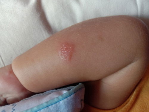 Bayi 3 bulan digigit nyamuk