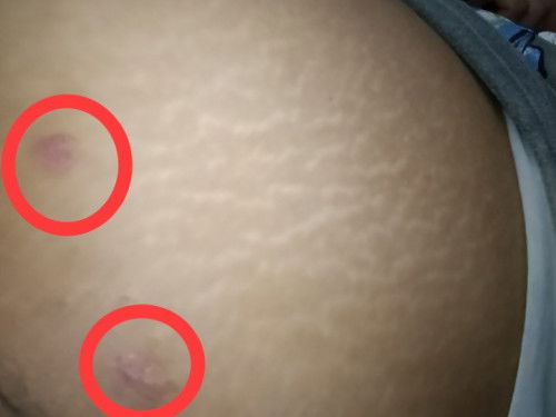 Normal lang ba mangati at magbutlig ang tyan ng buntis?