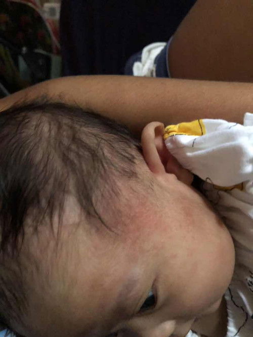 ผิวแดงๆเหมือนชํ้าๆแบบนี้เรียกว่าแพ้มั้ยคะ