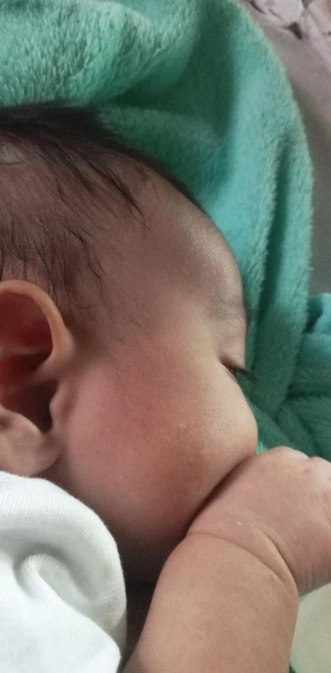 แพ้นมวัวกินนมถั่วเหลืองผื่นขึ้นแค่หน้า