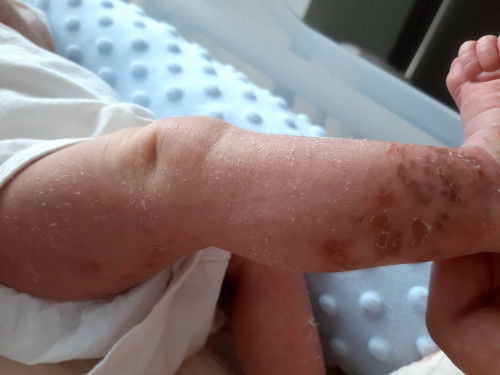 Ada masalah ke baby saya waktu lahir ada ruam dekat kakinya?tak surut lagi walau sudah lepas 2week