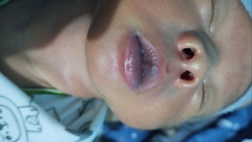 Bibir anak biru