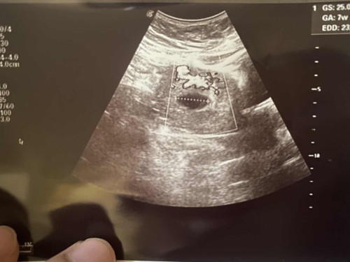 7week xad janin dan jantung..