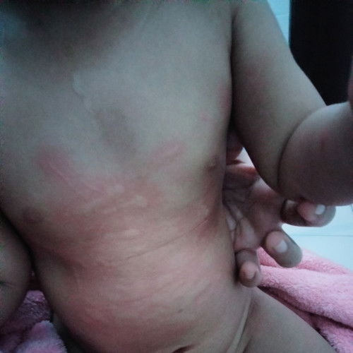 Bentol bentol kemerahan