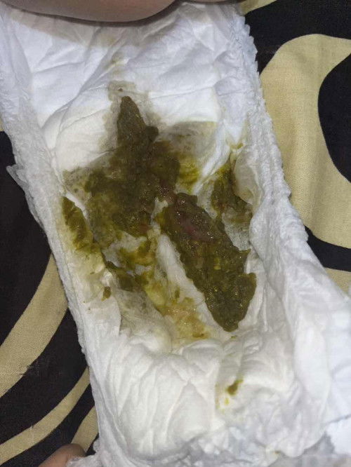 BAB bayi 6 bulan warna hijau, berlendir dan ada darah