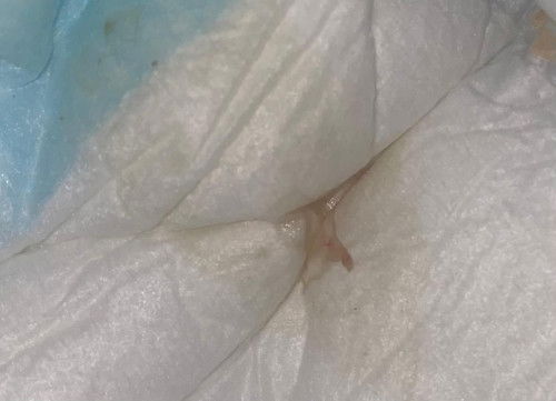 Ada darah sedikit pada pampers bayi saya