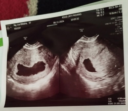 Abis usg, kata dokter suspek BO..