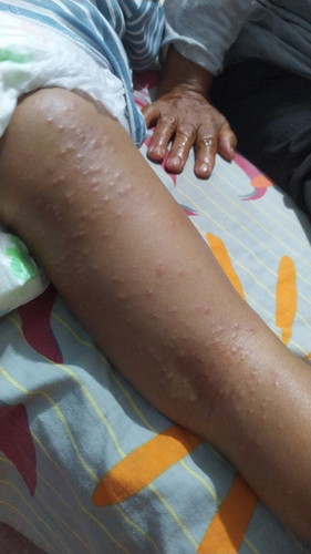 Ruam atau bruntusan di badan