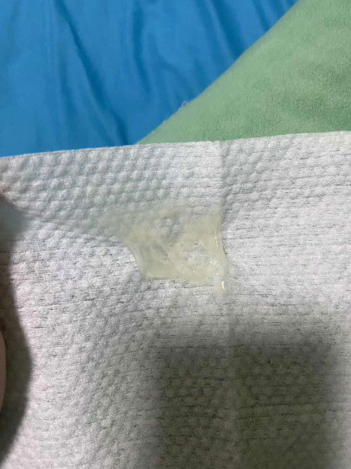 แบบนี้เรียกมูกใสหรือป่าวคะ