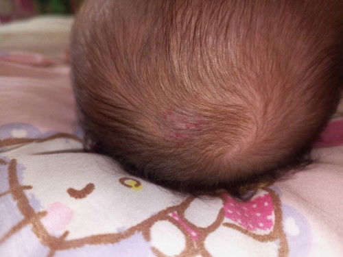 Ano Po kaya itong nasa ulo Ng baby ko pag ka panganak kopo sa knya ganyan napo na woworry Po ako