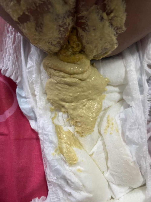 ทารก2เดือนถ่ายเป็นสีเหลืองอ่อนๆเหลืองซีดๆอันตรายไหม