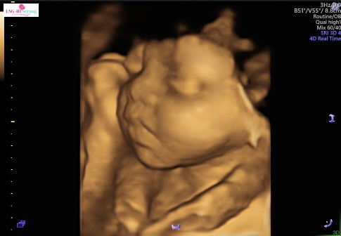 terrlilit tali pusar