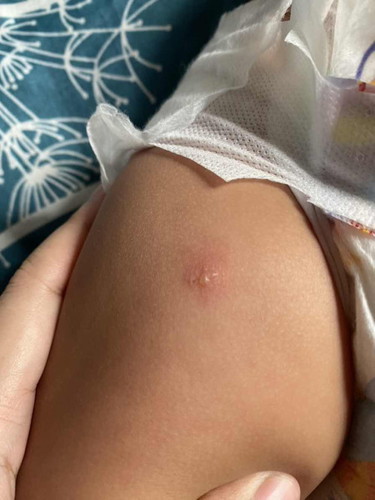 Kaki baby selalu kena gigit serangga