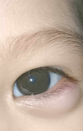 Nakaranas ba baby nyo ng ganito mga mii? Parang kagat ng ipis pero Isang buwan na may bakas pa rin?