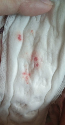 Implantation bleeding or spotting
