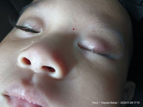 Kelopak mata baby 1 tahun naik biji.
