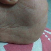 Hamil 37 weeks benjolan di telapak kaki,