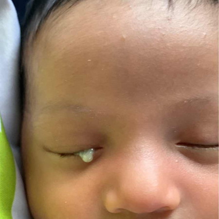 ขี้ตาแฉะ ยังไงดี