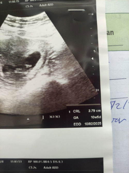 Akurat hpl bidan atau hasil usg dokter di usia kandungan 11 minggu
