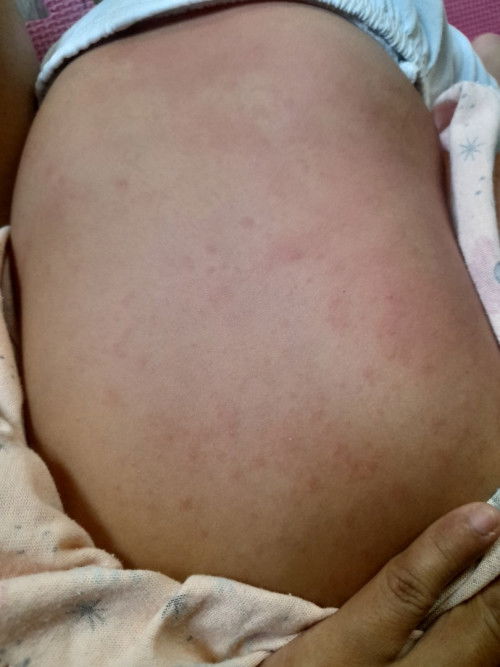 Ano pinagkaiba ng Tigdas hangin At tigdas