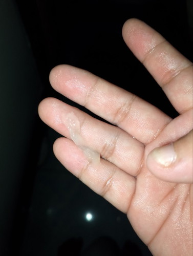 Discharge na parang sipon