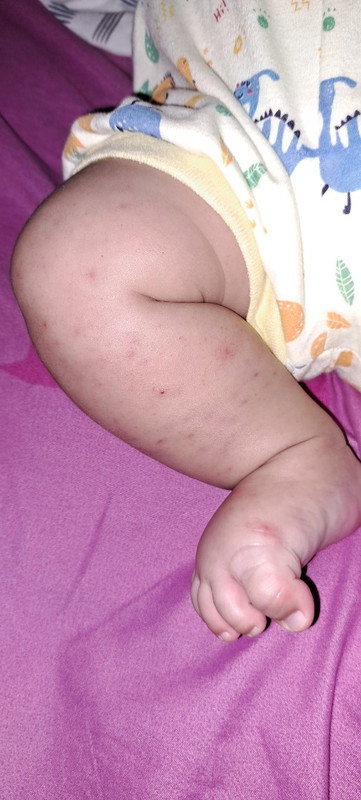 Kaki bayi 3 bulan bintik merah