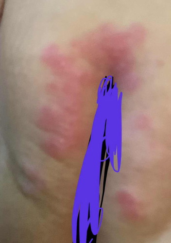 Ruam merah kat bahagian private